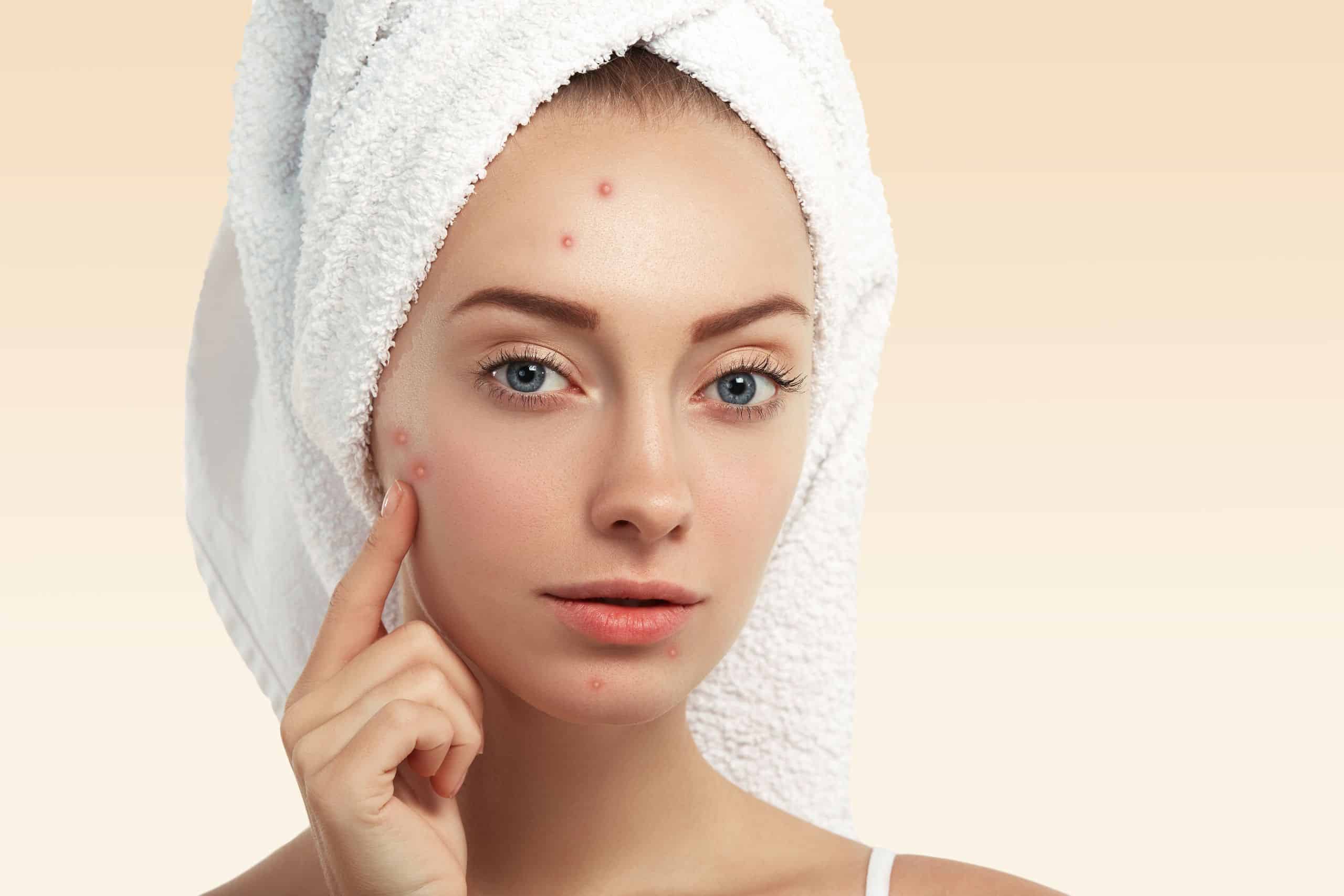 Advanced acne treatment in Kerala by Dr Vaishna Aesthetics