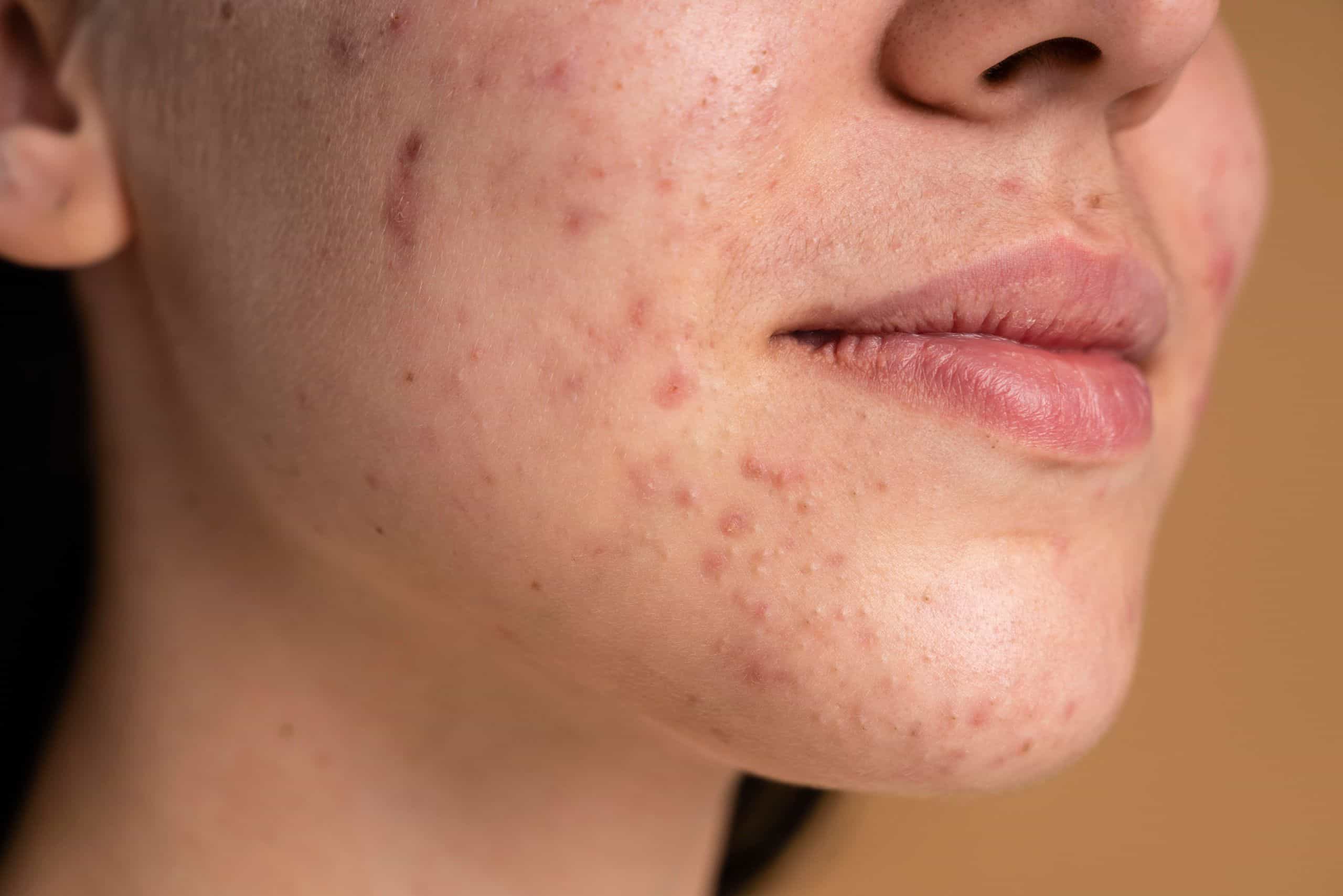 Acne scar treatment to smooth skin texture and reduce marks by Dr. Vaishna Aesthetic Physician